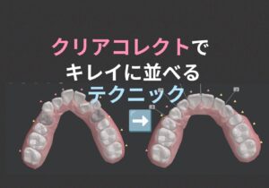 叢生 出っ歯の抜歯ケースをクリアコレクトで矯正 Ⅱ級ゴムかけは必ず必要 お口の再生博士のサムネイル画像