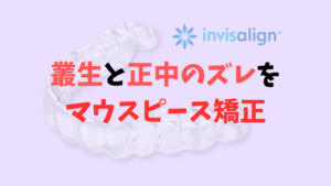 叢生をインビザライン非抜歯で矯正　Ⅱ級ゴムかけで正中のズレも治します　 お口の再生博士のサムネイル画像