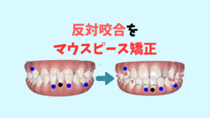 受け口　反対交合をインビザラインで矯正はⅢ級ゴムかけが必須　お口の再生博士のサムネイル画像