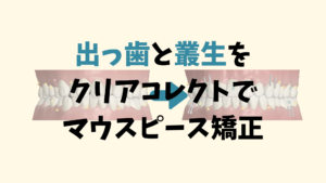 叢生と出っ歯をクリアコレクトで矯正　インビザラインのジェネリックです お口の再生博士のサムネイル画像