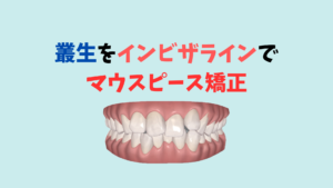 叢生をインビザラインで非抜歯　IPRで矯正　アライナーは３４枚の予定　お口の再生博士のサムネイル画像