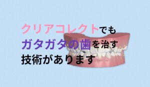 叢生 出っ歯をクリアコレクトは回転アタッチメントが無いのでペンデイングテクニックが必要 お口の再生博士のサムネイル画像