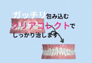 マウスピース矯正のクリアコレクトはアタッチメントの数は少ないが歯が動くので安心して下さい お口の再生博士のサムネイル画像