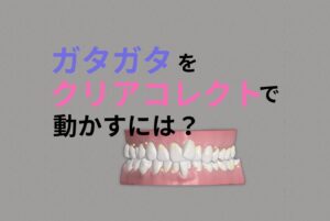 少ないアタッチメントでもゴムかけでインビザラインでなくともクリアコレクトで叢生が治ります お口の再生博士のサムネイル画像