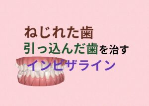 叢生をインビザラインはアタッチメントとゴムかけが有効 お口の再生博士のサムネイル画像