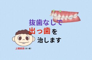 インビザラインで出っ歯はお勧めしない やらなきゃよかったと後悔するよ と言われました お口の再生博士のサムネイル画像