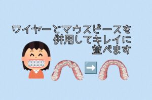 叢生と切端咬合をインビザラインで矯正 ワイヤー矯正で傾いた歯を 起こして開始 お口の再生博士のサムネイル画像