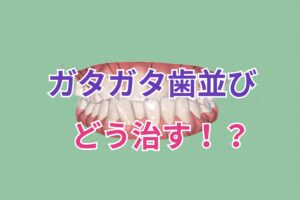 交叉咬合を抜歯してインビザラインで矯正 お口の再生博士のサムネイル画像