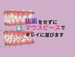 叢生と切端咬合を非抜歯インビザラインでゴムかけして矯正 お口の再生博士のサムネイル画像