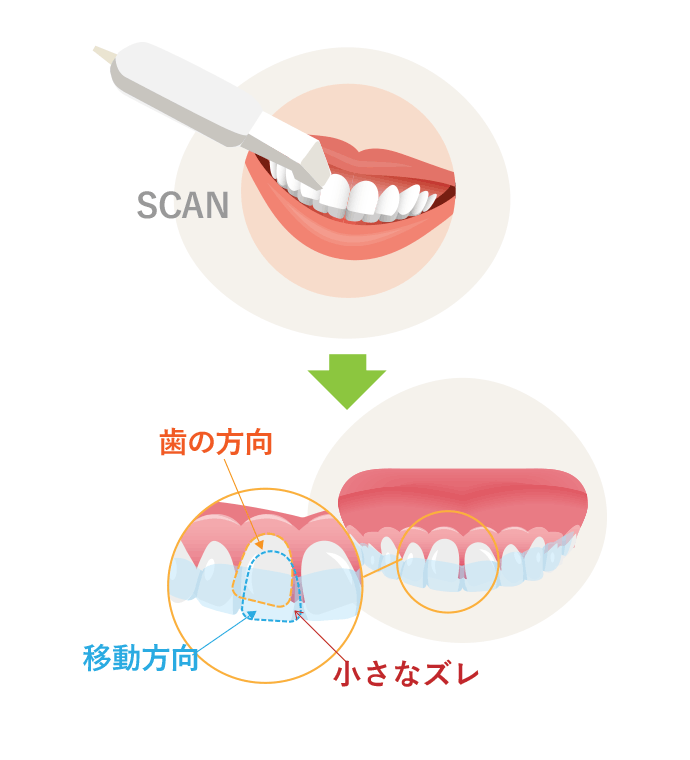 マウスピース矯正とは 歯並びを治す仕組み 広島 ナタリーデンタルクリニック