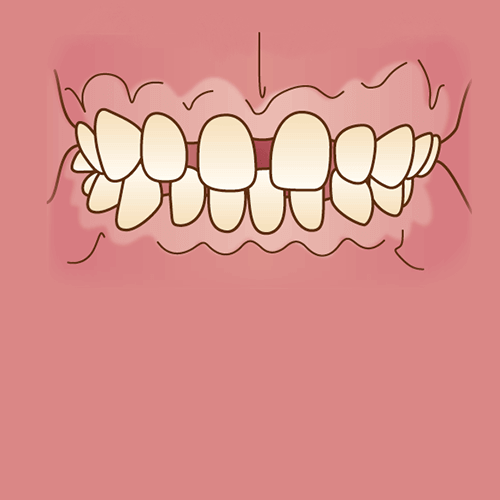 すきっ歯（空隙歯列）イラスト図